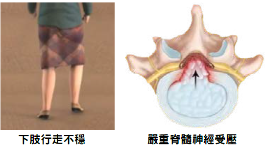 下肢行走不穩與嚴重脊髓神經受壓示意